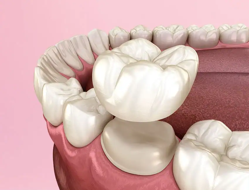 Dental Crown in Burlingame