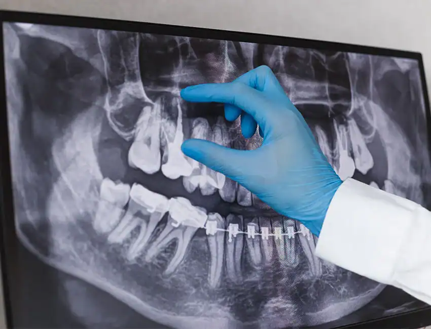Root canal in Burlingame