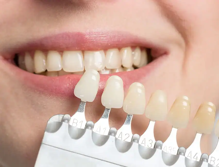 Teeth Whitening in Burlingame