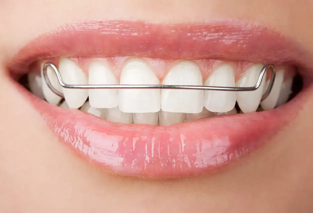 Retainers in Burlingame, CA