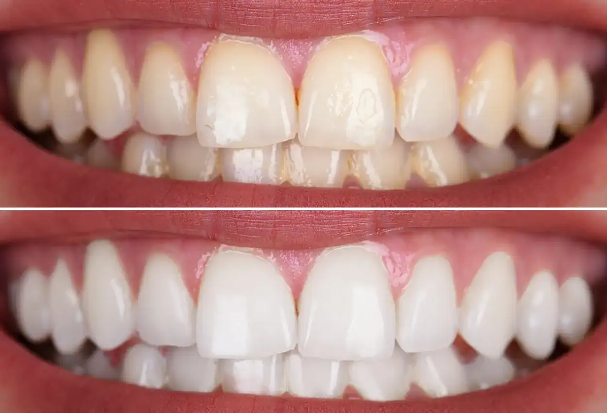 Professional Teeth Whitening