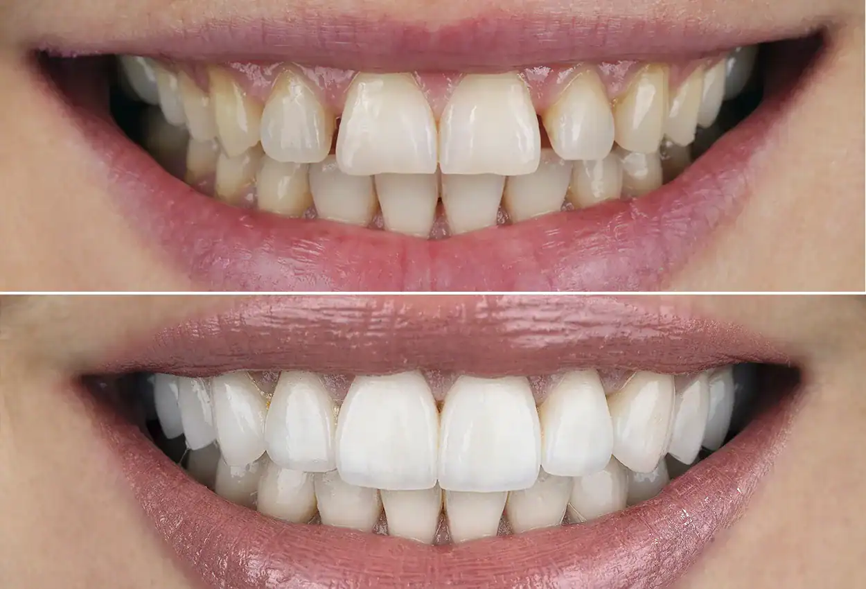 Before and after Dental Veneers