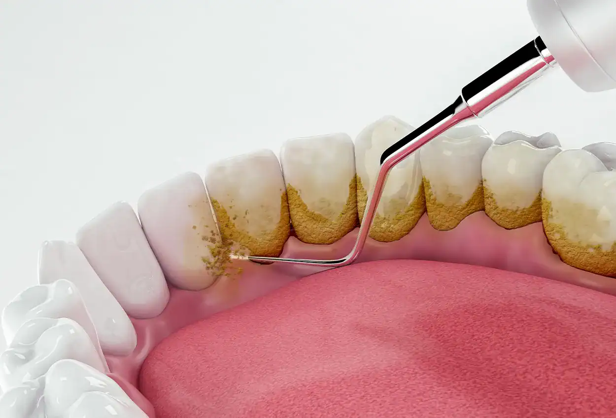 Teeth Cleaning