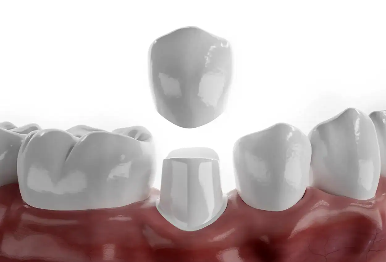Crowns