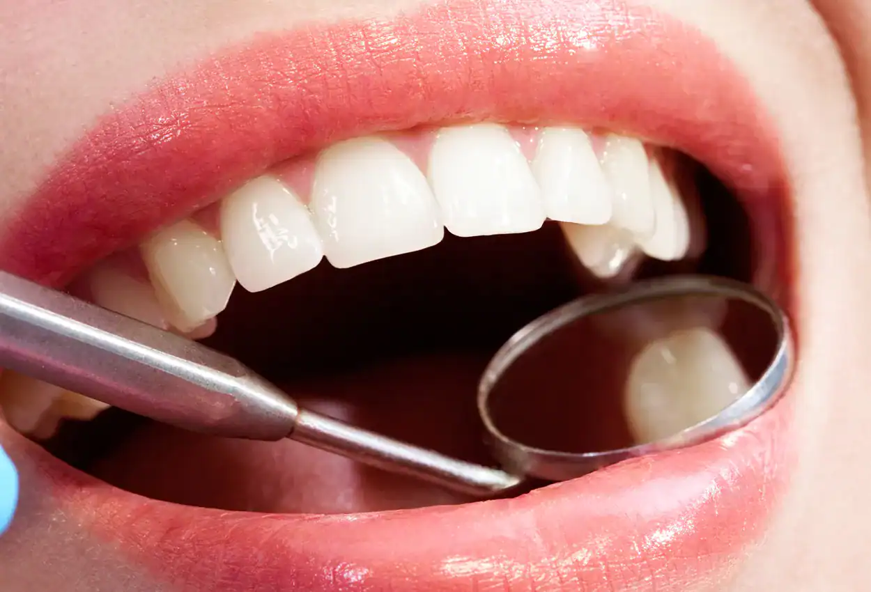 Composite Dental Fillings in Burlingame, CA