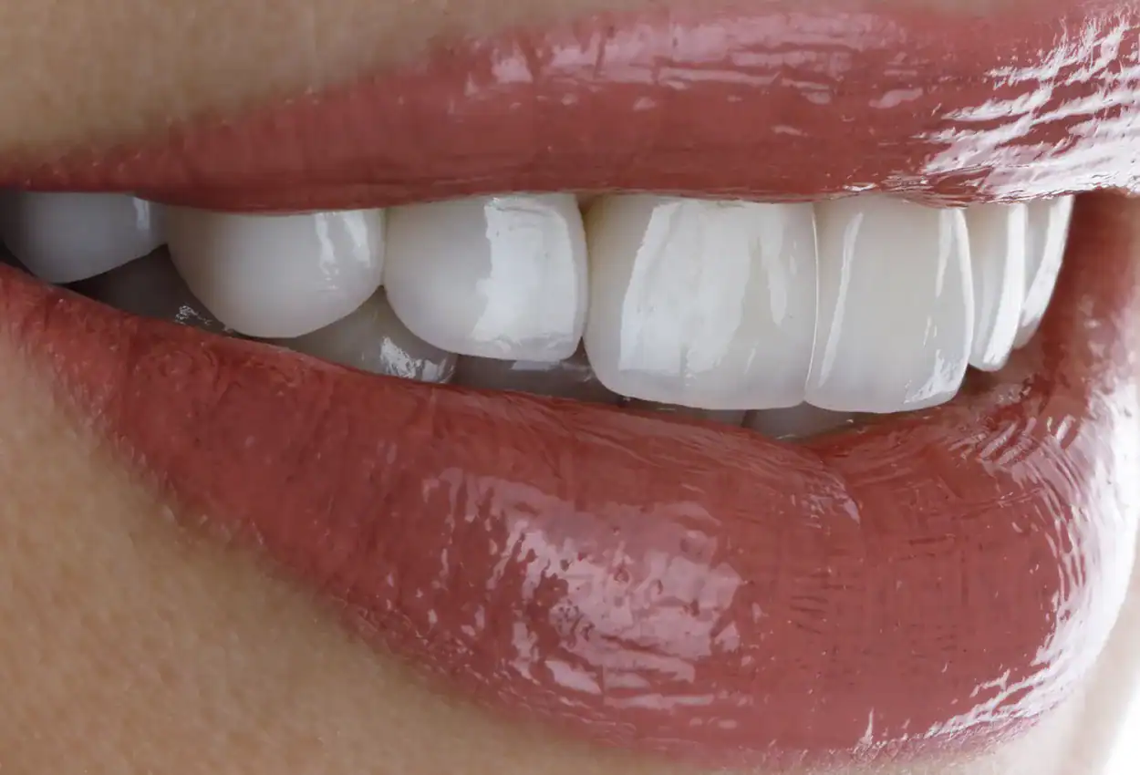 Dental Veneers in Burlingame, CA