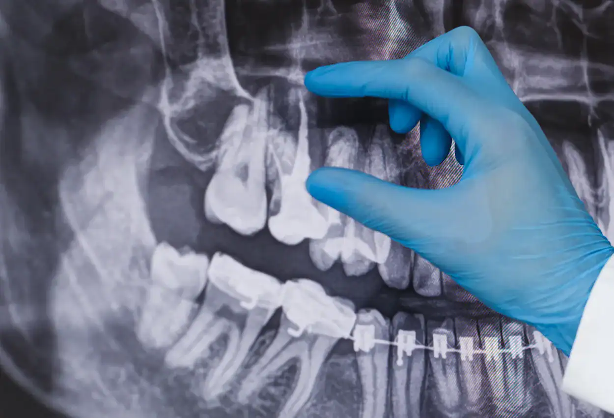 Root Canal Treatment in Burlingame, CA