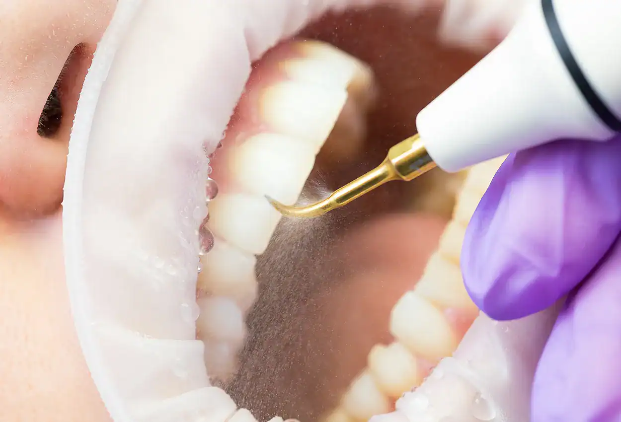 Dental Teeth Cleaning (Prophy) in Burlingame, CA