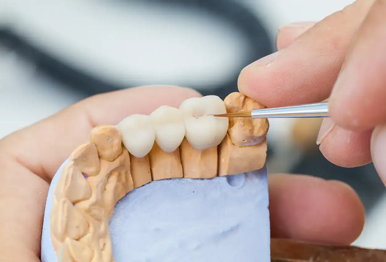 Dental Crowns in Burlingame, CA