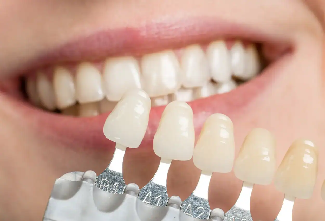 Professional Teeth Whitening in Burlingame, CA