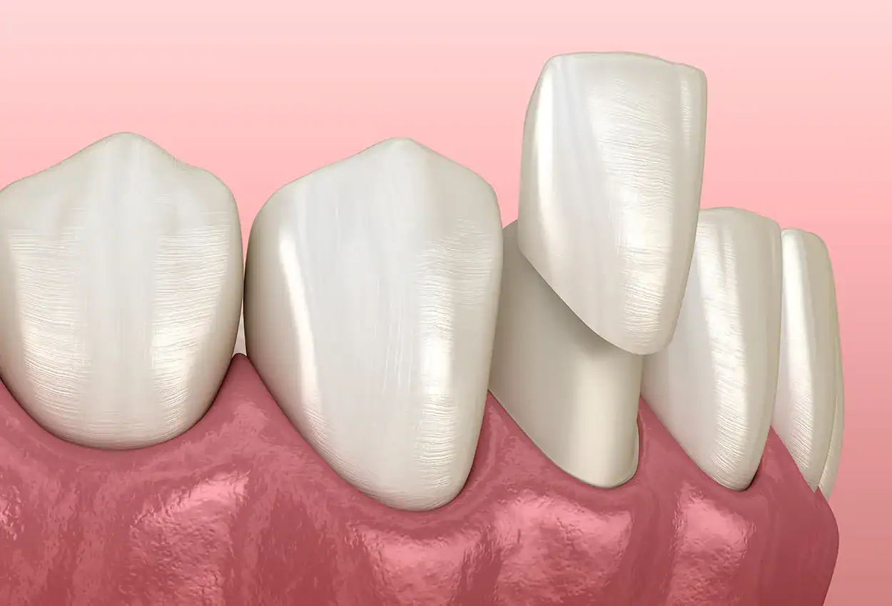Veneers